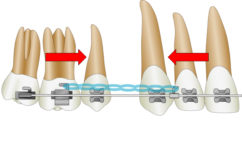 通常の矯正歯科治療