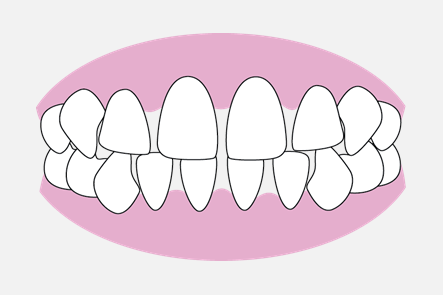 空隙歯列