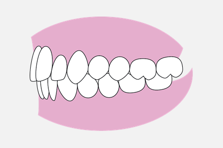 理想咬合側面
