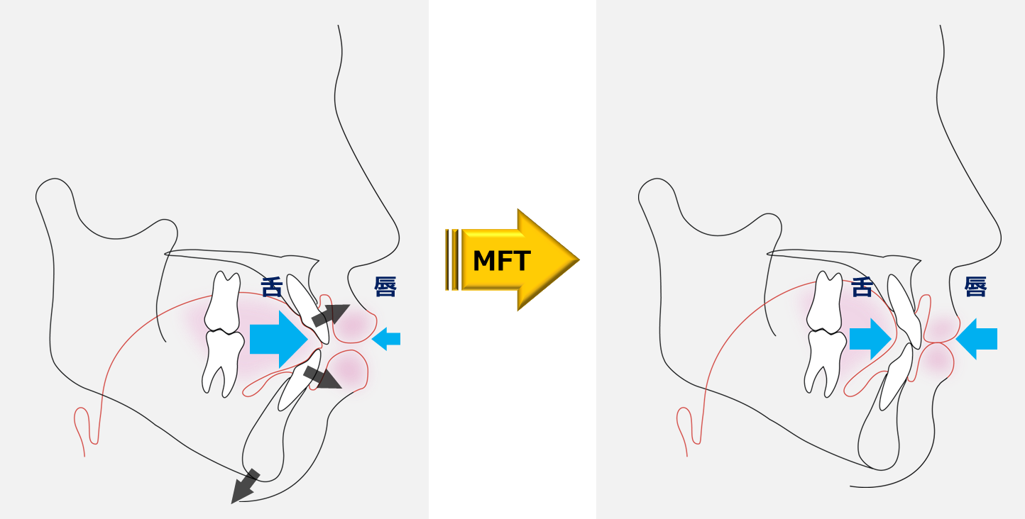 筋機能療法,　MFT